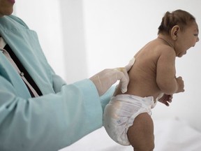 FILE - In this Friday, Feb. 12, 2016 file photo, Lara, who is less then 3-months old and was born with microcephaly, is examined by a neurologist at the Pedro I hospital in Campina Grande, Paraiba state, Brazil. On Wednesday, April 13, 2016, the U.S. Centers for Disease Control and Prevention said there's enough evidence now to declare that the Zika virus during the mother's pregnancy causes the microcephaly birth defect and other brain abnormalities. (AP Photo/Felipe Dana, File)