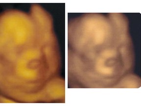 A compilation of 3D ultrasound scans provided by parents of BabyView 3D Prenatal Imaging. Handout/Postmedia Network