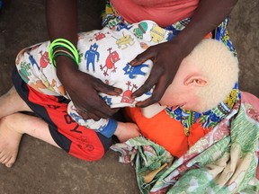 Edna Cedrick, 26, holds her surviving albino son after his twin brother who had albinism was snatched from her arms in a violent struggle in this Tuesday, May, 24, 2016 photo in Machinga about 200 kilometres north east of Blantyre Malawi. Cedrick says she is haunted daily by images of the decapitated head of her nine-year-old son. (AP Photo/Tsvangirayi Mukwazhi)