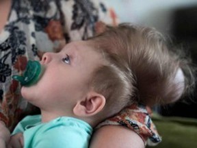 Bentley Yoder before surgery. He was born with a rare condition in which his brain was growing outside of his skull. (Katherine C. Cohen-Boston Children's Hospital/HO)