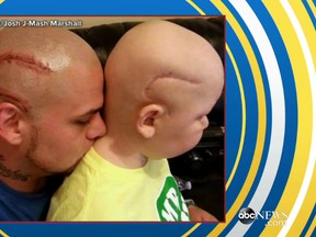 Josh Marshall tells ABC News his 8-year-old son Gabriel was left bald with a large horseshoe scar on the right side of his head after undergoing surgery to remove a brain tumour. Marshall says Gabriel was so self-conscious that "he felt like a monster." (ABC News screengrab)