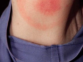 In this photo released by the Centers for Disease Control and Prevention, this photograph depicts a rash in the pattern of a bulls-eye, which formed after a tick bite.