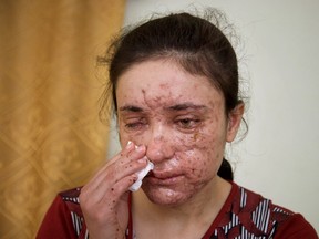 Lamiya Aji Bashar, an 18-year-old Yazidi girl who escaped her Islamic State group enslavers, talks to The Associated Press in northern Iraq in this May 5, 2016 photo. She described how she was abducted along with her sisters and brothers when IS overran her village in 2014 and was passed around from militant to militant, trying to escape many times. Finally she succeeded in March, but only after a mine exploded, killing two girls fleeing with her and leaving Bashar's face scarred and blinding her in one eye. (AP Photo/Balint Szlanko)
