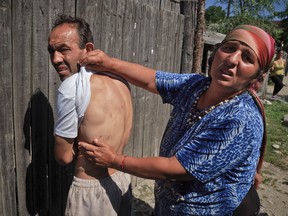 A woman shows bruises on a man's body, allegedly from being hit by gendarmes, in Gamacesti, Romania,Thursday, July 14, 2016, a day after a large police raid on the homes of people suspected of enslaving vulnerable individuals took place in the village. Authorities in Romania have formally detained 38 people, after a raid Wednesday in a rural mountain town on the homes of suspects, on suspicion they took dozens of vulnerable individuals as slaves, kidnapped, chained them up, and forced them to work or fight each other for entertainment. (AP Photo/Vadim Ghirda)