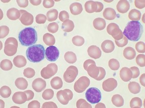 File photo showing a high-power magnification of a  blood smear showing chronic lymphocytic leukemia. (Wikimedia Commons/Mary Ann Thompson/HO)