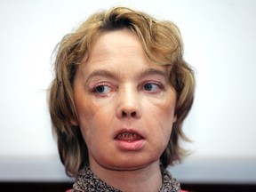 In this Feb. 6, 2006 file photo, Isabelle Dinoire, the woman who received the world's first partial face transplant with a new nose, chin and mouth, in an operation on Nov. 27, 2005, addresses reporters during her first press conference since the transplant at the Amiens hospital, northern France. The 38-year-old woman was mauled by a dog, leaving her with severe facial injuries that her doctors said made it difficult for her to speak and eat. Dinoire who received the world’s first partial face transplant has died, 11 years after surgery that set the stage for dozens of other transplants around the world. (AP Photo/Michel Spingler, FILE)