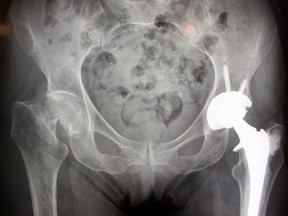 Patient X-ray of broken right hip. (Postmedia files)