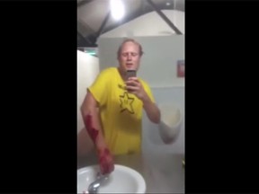 Johnny Bonde shows the bite wounds he got from a crocodile after he tried to take a selfie with it. (YouTube screengrab)