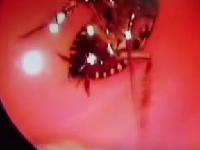 Video of doctors removing a roach from a woman's skull.
