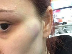 Supplied photo
A Sudbury-area woman said she narrowly escaped a vicious roadside attack from an unidentified man near Sturgeon Falls last week. You can see injuries to her face and neck.
