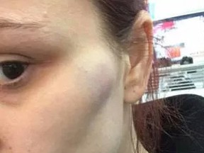 A Sudbury-area woman said she narrowly escaped a vicious roadside attack from an unidentified man near Sturgeon Falls last week. You can see injuries to her face and neck.
Supplied photo