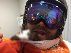 Ski instructor Natty Hagood was impaled in the face by an 18-inch branch after a snowboarding accident. Fifteen stitches were needed to close up the wound. (Twitter Photo)