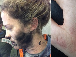 An unidentified woman's headphones exploded on a flight from Beijing to Melbourne, causing burns to her face and hands. (Australian Transport Safety Bureau Photos)