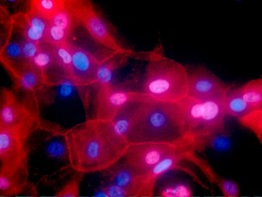 This undated fluorescence-colored microscope image made available by the National Institutes of Health in September 2016 shows a culture of human breast cancer cells. Environmental risks and heredity get the most blame for cancer, but new research released on Thursday, March 23, 2017 suggests random chance may play a bigger role than people realize: Healthy cells naturally make mistakes when they multiply, typos in your DNA that can leave new cells carrying cancer-prone genetic mutations. (Ewa Krawczyk/National Cancer Institute via AP)