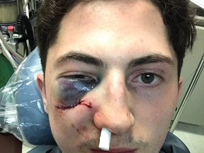 Zach Werenski of the Columbus Blue Jackets after taking a puck to the face in Game 3 against the Pittsburgh Penguins (Twitter)