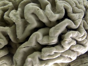 In this Oct. 7, 2003, file photo, a section of a human brain with Alzheimer's disease is on display at the Museum of Neuroanatomy at the University at Buffalo, in Buffalo, N.Y. There are no proven ways to stave off Alzheimer's, but a new report raises the prospect that avoiding nine risks starting in childhood just might delay or even prevent about a third of dementia cases.(AP Photo/David Duprey)
