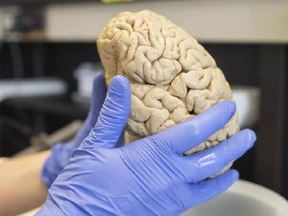 In this July 29, 2013 photo, a researcher holds a human brain in a laboratory at Northwestern University's cognitive neurology and Alzheimer's disease centre in Chicago. SCOTT EISEN / CP