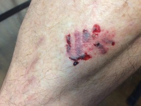 George Eadie was bitten by a dog while he was biking along the Laurentian trails last week. Supplied photo
