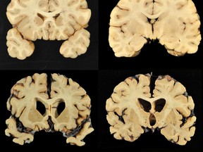 This combination of photos provided by Boston University shows sections from a normal brain, top, and from the brain of former University of Texas football player Greg Ploetz, bottom, in stage IV of chronic traumatic encephalopathy. (Dr. Ann McKee/BU via AP)