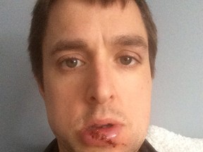 Doug Gardner had major dental surgery after he was struck in the face with a goalie stick 18 months ago in a Dorchester beer league hockey game. The goalie, Jason Ashton, 37, has been sentenced to 90 days of house arrest and two years of probation -- prohibiting him from playing hockey during that time. (SUPPLIED BY DOUG GARDNER)