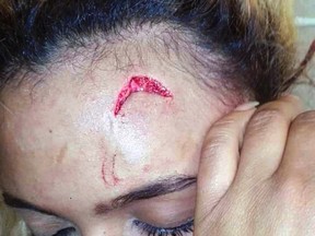 In this photo provided by Debbie Engels and taken on Monday, Aug. 14, 2017, Gabriella Engels is seen with an injury to her forehead in Johannesburg, South Africa. Twenty-year-old model Gabriella Engels has accused Grace Mugabe of assaulting her on Sunday, Aug. 13 while she was visiting Mugabe's sons in a hotel room in an upscale Johannesburg suburb. She claims the first lady's bodyguards stood by and watched as Mugabe attacked her. (Debbie Engels via AP)