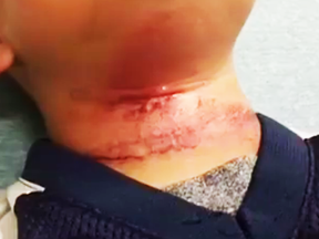 A picture reportedly showing the 8-year-old unidentified boy's neck. (News One Now)