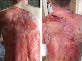 Big open wounds are decreasing in size and other chronic wounds have completely closed up, Tina Boileau recently wrote on Facebook. Before (left) and after (right) shots above show how Pitre’s skin is healing.
