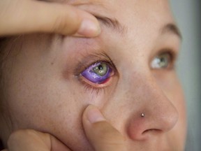 Catt Gallinger, who had a botched ink injection in her eyeball, shows the amount of swelling in her eye, at home in Ottawa on Friday, Sept. 29, 2017. THE CANADIAN PRESS/Justin Tang