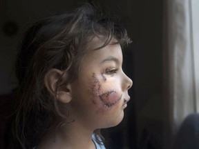 Karma Jariett, 6, received 125 stitches to her face and leg after after being mauled by a dog. DAX MELMER / POSTMEDIA