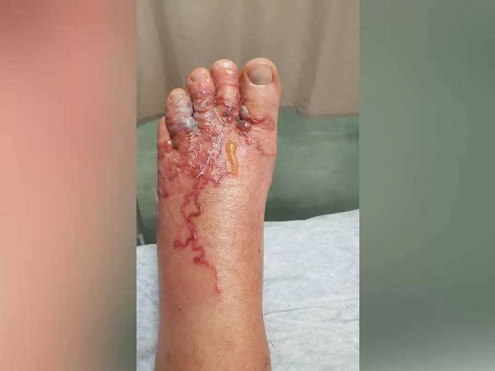Canadian couple gets hookworms on vacation, has to go to US for medicine