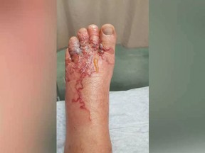 A close-up of Windsor resident Eddie Zytner’s left foot at the height of its hookworm infection in January 2018. COURTESY OF EDDIE ZYTNER / Postmedia