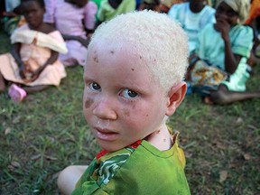 An albino child poses at a picnic organised by the Tanzania Red Cross Society (TRCS) at the government-run school for the disabled in Kabanga, in the west of the country near the town of Kigoma on Lake Tanganyika June 5, 2009. The school began to take in albino children late last year after albinos were being killed in Tanzania and neighbouring Burundi by people who allegedly sell their body parts for use in witchcraft.  (REUTERS/Alex Wynter)