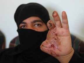 A Syrian man shows his hand, which he said was injured by Syrian security forces, at a temporary shelter after undergoing multiple reconstructive surgeries at a Red Crescent Hospital in Amman February 13, 2012. REUTERS/Ali Jarekji