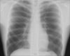 Chest X-ray image. (Photo credit: Wikipedia)