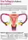 The Fallopian tubes - a culprit in ovarian cancer