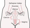 In the majority of high grade serous carcinomas – the most fatal and most common subtype of ovarian cancer – the initiating site is now believed to be the Fallopian tubes, not the ovaries.  When the 5-6 cm long tubes are removed for ovarian cancer prevention, they are cut flush to the outside of the uterus.Graphic credit: Wikipedia