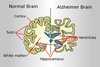 Drawing comparing brain of an Alzheimer’s patient to a healthy brain (Photo credit: Wikipedia)