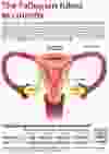 The Fallopian tubes -culprit in ovarian cancer.