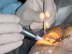 Cataract_surgery