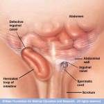 Inguinal hernia, Mayo Clinic Foundation for Medical Education and Research