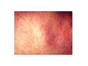 FILE: Measles is a very contagious (easily spread) infection that causes a rash all over your body. It is also called rubeola or red measles.
