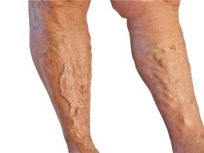 Across Canada, provinces have left the treatment of varicose veins (pictured) to private clinics by limiting hospital-based treatment to surgery, usually called vein stripping. In B.C., a patient will be told he or she can wait a few years for surgery or walk across the street to have an equally effective, less invasive treatment right away as long as they’re willing to pay several thousand dollars.