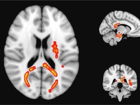 Areas of significantly reduced myelin in athletes with concussion two weeks after an injury.