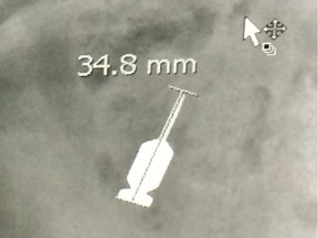 An X-ray submitted as part of a lawsuit shows a drill bit that the plaintiff alleges was negligently dropped into his throat.