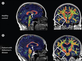 Multimodal image of brains with and without Alzheimer's disease.