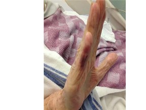 This photo shows the right hand of Grace Marriott, 88, after a brazen robber pulled off her ring.   — submitted photo