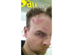 Sean McQuillan shows the scrapes and bump on his head that he alleges were caused after Bay security staff at Lougheed Town Centre accosted him — even though he had the receipt for the two items he was carrying in his pocket.
