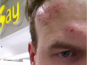Sean McQuillan shows the scrapes and bump on his head that he alleges were caused after Bay security staff at Lougheed Town Centre accosted him — even though he had the receipt for the two items he was carrying in his pocket.
