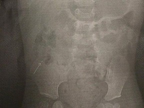X-ray shows a nail in the abdomen of an eight-month-old boy.  Submitted Photo/Times Colonist