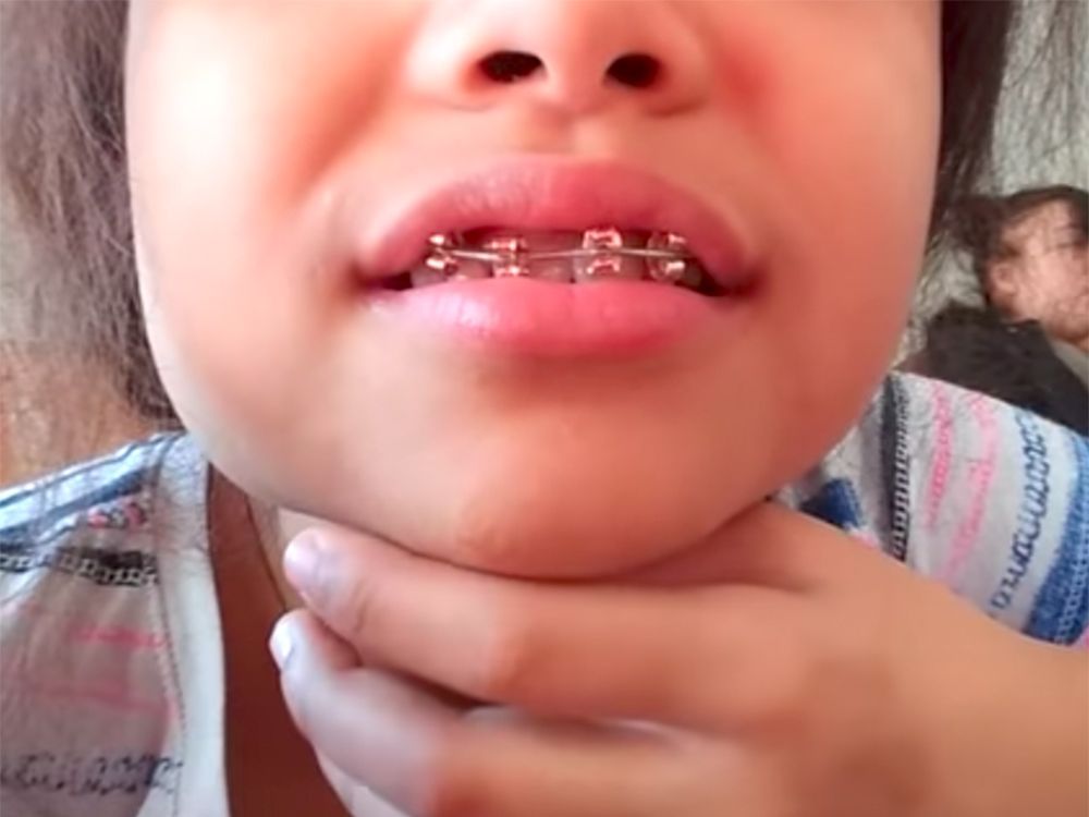 Make fake braces with earring backs and a rubber band